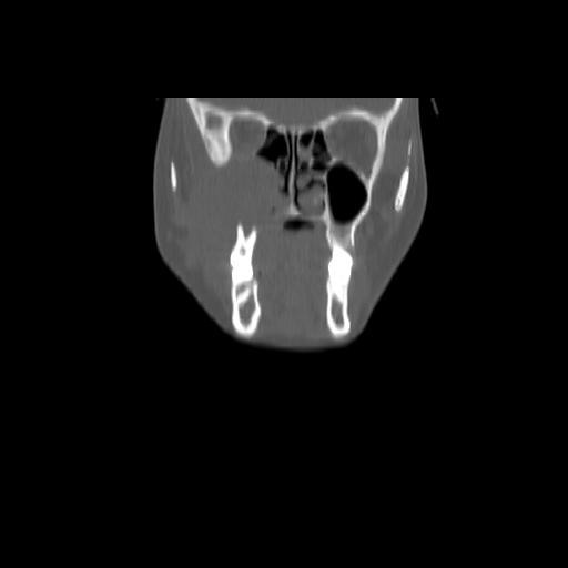 Carcinoma of the maxillary antrum (Radiopaedia 53805-59888 Coronal bone window 41).jpg