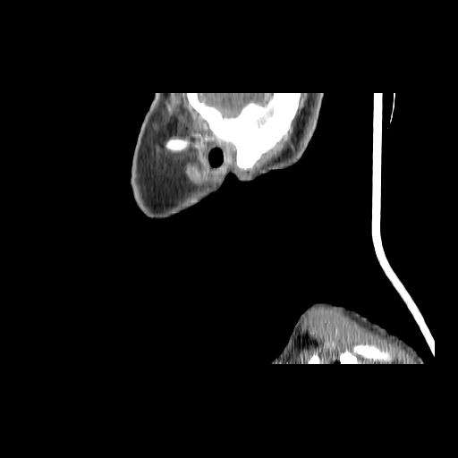 Carcinoma of the maxillary antrum (Radiopaedia 53805-59888 Sagittal C+ delayed 23).jpg