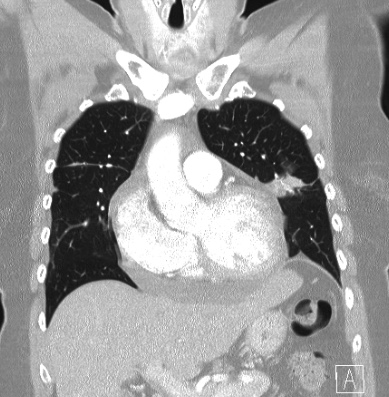 File:Cardiac sarcoidosis (Radiopaedia 74548-85534 Coronal lung window 21).jpg