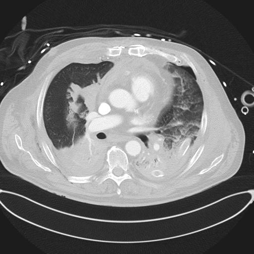 Cardiac trauma (Radiopaedia 32874-33858 Axial lung window 27).jpg