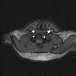 Carotid artery dissection (Radiopaedia 28441-28689 Axial MRA 23).jpg