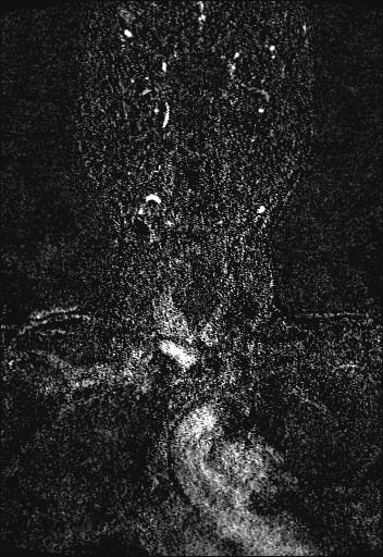 Carotid artery dissection (Radiopaedia 28441-28689 Coronal MRA 11).jpg