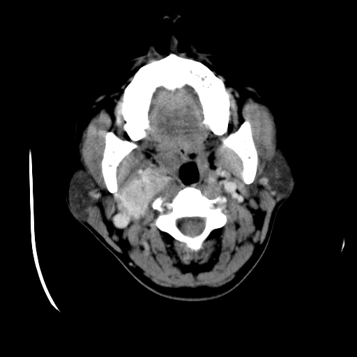 File:Carotid body tumor (Radiopaedia 27890-28124 A 10).jpg