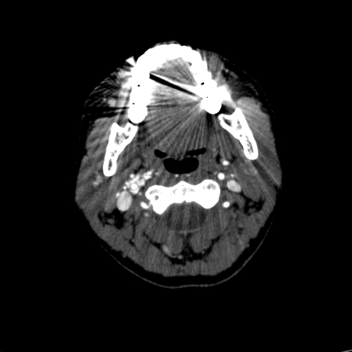 File:Carotid body tumor (Radiopaedia 39845-42300 B 54).jpg