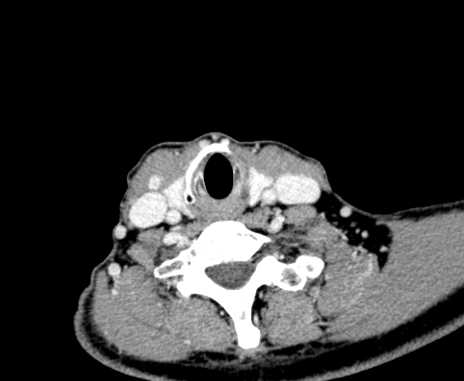 Carotid body tumor (Radiopaedia 61750-69757 Axial Post contrast 89).jpg
