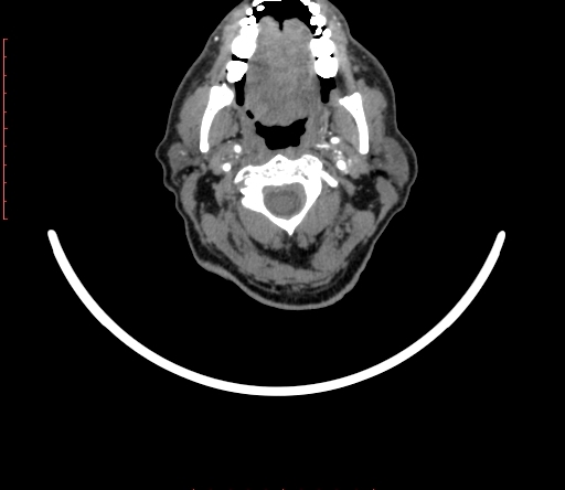 Carotid body tumor (Radiopaedia 66785-76116 B 1).jpg