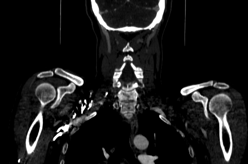 File:Carotid bulb pseudoaneurysm (Radiopaedia 57670-64616 D 67).jpg