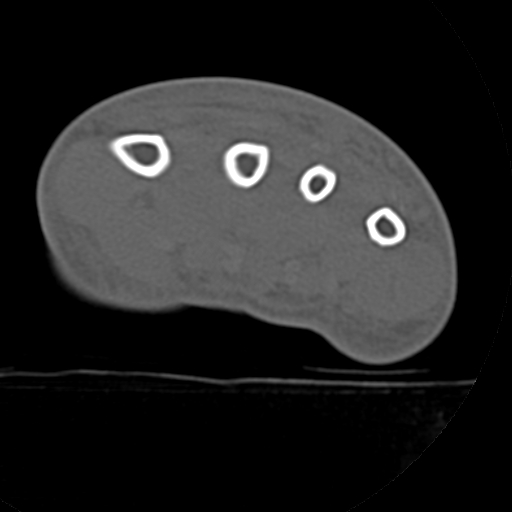 File:Carpo-metacarpal fracture-dislocations with hamatum split fracture (Radiopaedia 18482-18343 Axial bone window 2).jpg