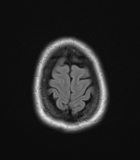 File:Cavernoma with bleed - midbrain (Radiopaedia 54546-60774 Axial FLAIR 28).png