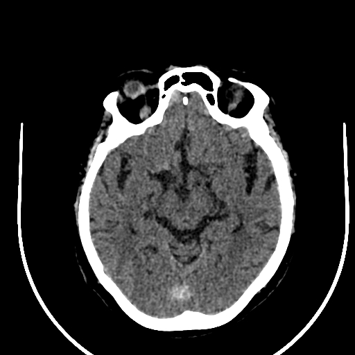File:Cavernous hemangioma of the cerebellar falx (Radiopaedia 73025-83723 Axial non-contrast 58).jpg