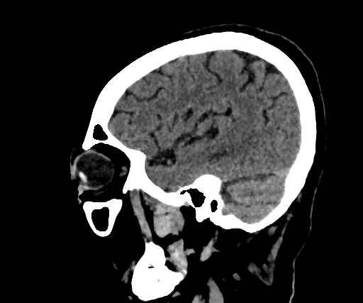 Cavernous hemangioma of the cerebellar falx (Radiopaedia 73025-83723 B 249).jpg