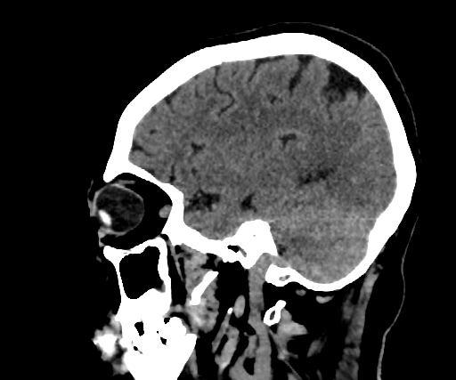 Cavernous hemangioma of the cerebellar falx (Radiopaedia 73025-83723 B 95).jpg