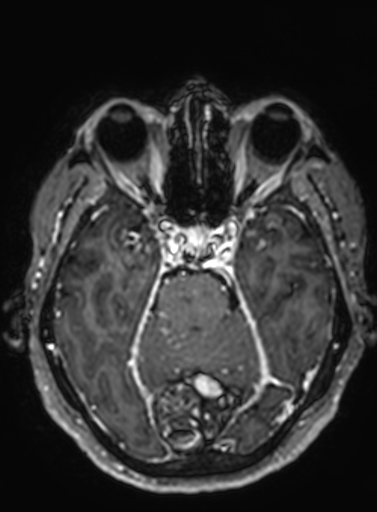 Cavernous hemangioma of the cerebellar falx (Radiopaedia 73025-83724 Axial T1 C+ 225).jpg
