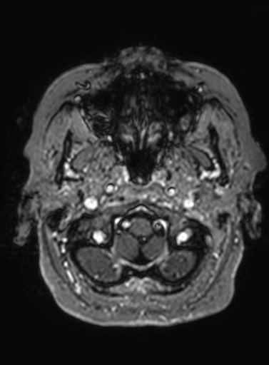 Cavernous hemangioma of the cerebellar falx (Radiopaedia 73025-83724 Axial T1 C+ 312).jpg