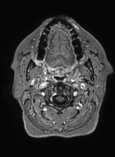 Cavernous hemangioma of the cerebellar falx (Radiopaedia 73025-83724 Axial T1 C+ 350).jpg