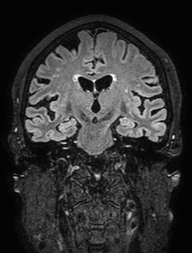 Cavernous hemangioma of the cerebellar falx (Radiopaedia 73025-83724 Coronal FLAIR 179).jpg