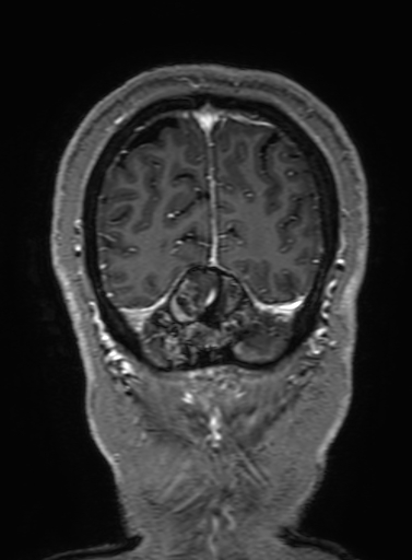 Cavernous hemangioma of the cerebellar falx (Radiopaedia 73025-83724 Coronal T1 C+ 330).jpg