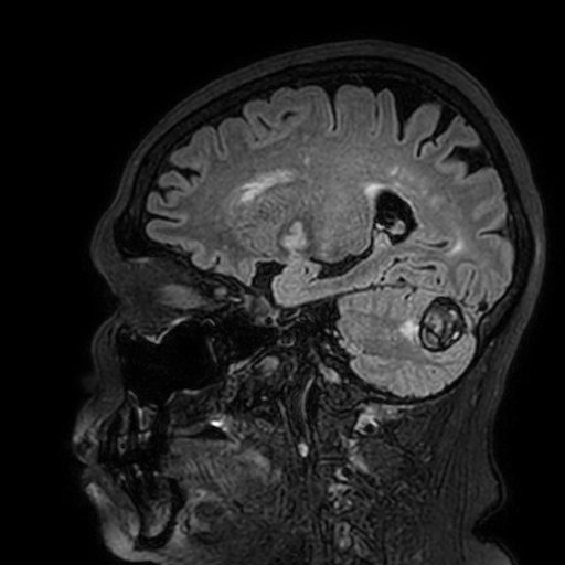 Cavernous hemangioma of the cerebellar falx (Radiopaedia 73025-83724 Sagittal FLAIR 72).jpg