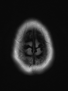 File:Cavernous malformation (cavernous angioma or cavernoma) (Radiopaedia 36675-38237 Axial T2 FLAIR 21).png