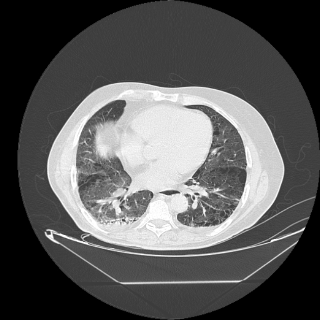Cavitating bronchogenic carcinoma (Radiopaedia 44489-48162 Axial lung window 54).jpg