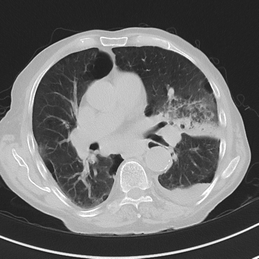 Cavitating pneumonia - lingular segments (Radiopaedia 34386-35678 Axial lung window 31).png