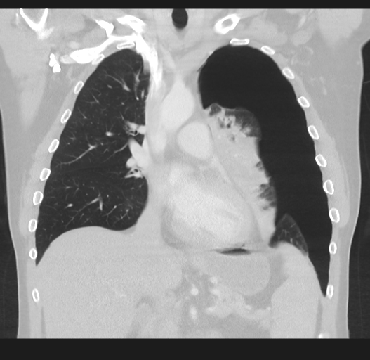 File:Cavitating pneumonia complicated by pneumothorax (Radiopaedia 48149-52994 Coronal lung window 27).png
