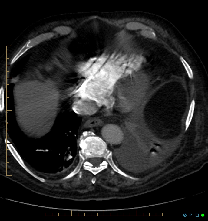 Cavitating pulmonary infarction (Radiopaedia 54634-60849 Axial C+ CTPA 65).jpg