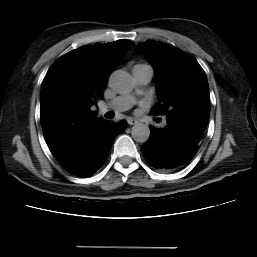 File:Cavitating pulmonary metastases (Radiopaedia 89545-106544 Axial non-contrast 28).jpg
