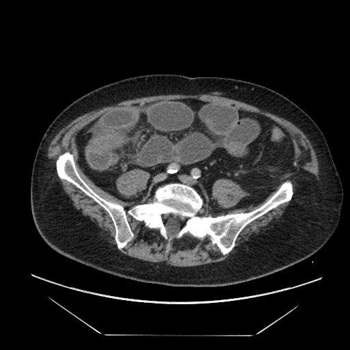 Cecal adenocarcinoma (Radiopaedia 64871-73817 A 66).jpg