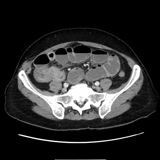 Cecal adenocarcinoma (Radiopaedia 75909-87331 A 64).jpg