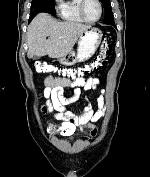 File:Cecal cancer with appendiceal mucocele (Radiopaedia 91080-108651 D 16).jpg