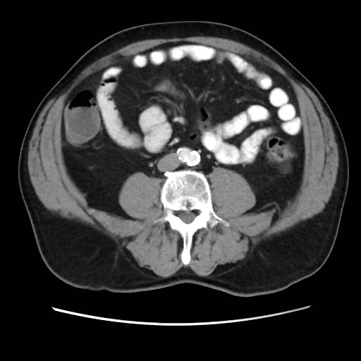 Cecal mass causing appendicitis (Radiopaedia 59207-66531 A 51).jpg
