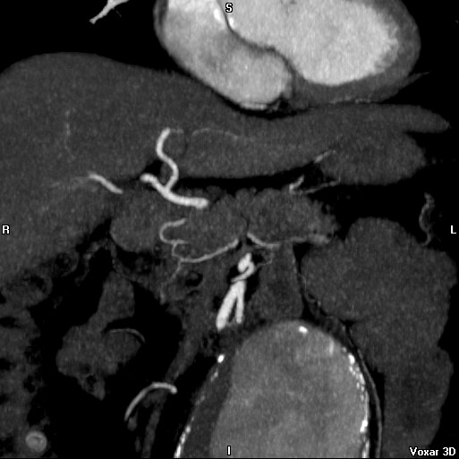 File:Celiac artery anatomy (Radiopaedia 16763-16476 A 3).jpg