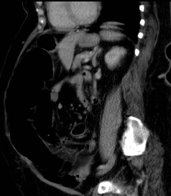 File:Celiac artery compression syndrome (Radiopaedia 24287-24570 A 10).jpg