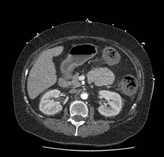 Celiac artery severe stenosis and dissection (Radiopaedia 44128-47842 B 36).jpg