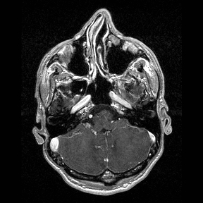 Central-variant posterior reversible encephalopathy syndrome (PRES) (Radiopaedia 43880-47358 Axial T1 C+ 28).jpg