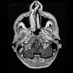 Central-variant posterior reversible encephalopathy syndrome (PRES) (Radiopaedia 43880-47358 Axial T1 C+ 7).jpg