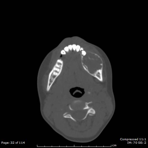 File:Central giant cell granuloma (Radiopaedia 45612-49754 Axial bone window 16).jpg