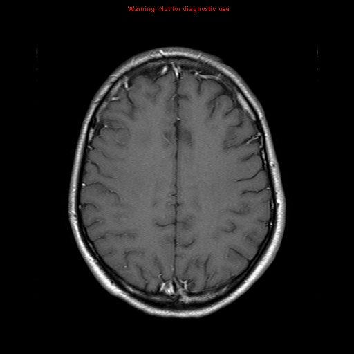 File:Central nervous system vasculitis (Radiopaedia 8410-9235 Axial T1 C+ 17).jpg