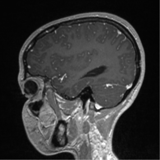 File:Central neurocytoma (Radiopaedia 37664-39557 Sagittal T1 C+ 71).png