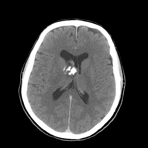 Central neurocytoma (Radiopaedia 68725-78432 Axial C+ 47).jpg