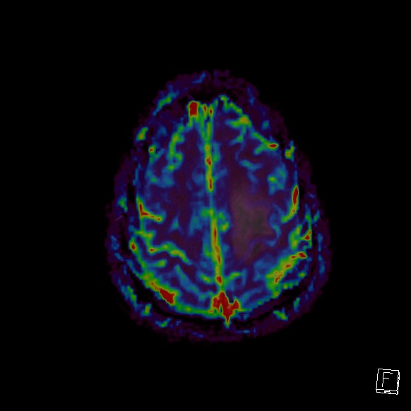 Central neurocytoma (Radiopaedia 84497-99872 Axial Perfusion 54).jpg