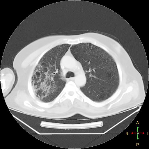 File:Centrilobular emphysema - with superimposed infection (Radiopaedia 24389-24683 lung window 10).jpg