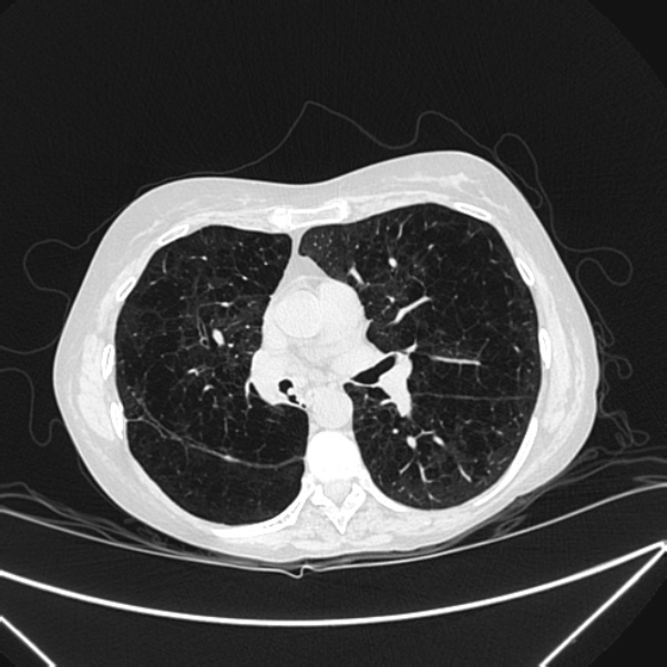 Centrilobular pulmonary emphysema (Radiopaedia 24495-24789 Axial lung window 48).jpg