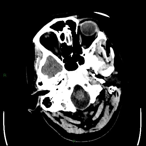 Cerebellar abscess (Radiopaedia 78135-90671 Axial non-contrast 15).jpg