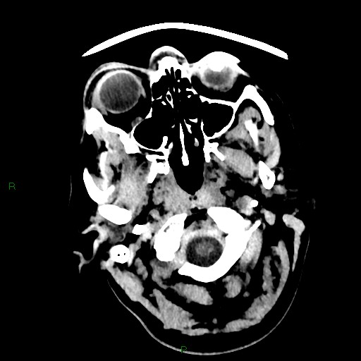 Cerebellar abscess (Radiopaedia 78135-90671 Axial non-contrast 4).jpg