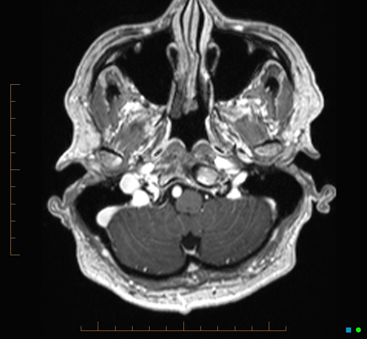 Cerebellar gangliocytoma (Radiopaedia 65377-74422 Axial T1 C+ 8).jpg