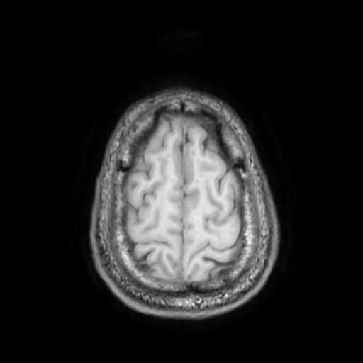 File:Cerebellar hemangioblastoma (Radiopaedia 88055-104622 Axial T1 30).jpg