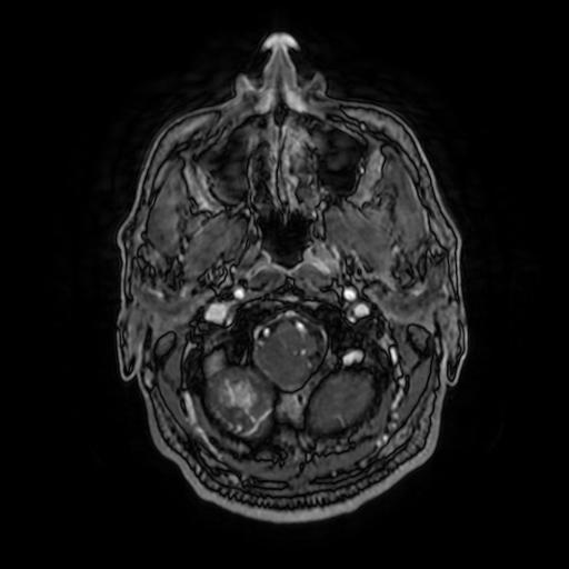 File:Cerebellar hemangioblastoma (Radiopaedia 88055-104622 Axial T1 C+ 32).jpg