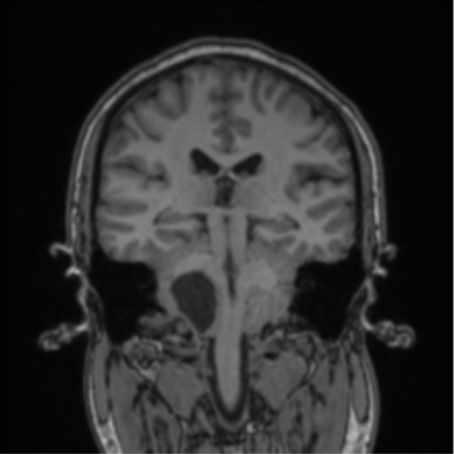 Cerebellar hemangioblastomas and pituitary adenoma (Radiopaedia 85490-101176 Coronal T1 41).png
